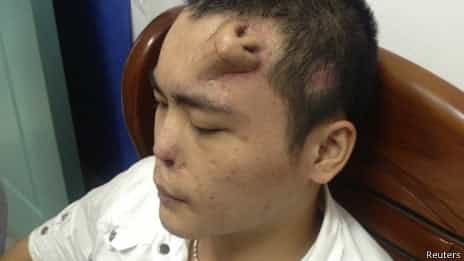 Cómo hacer crecer una nariz en la frente