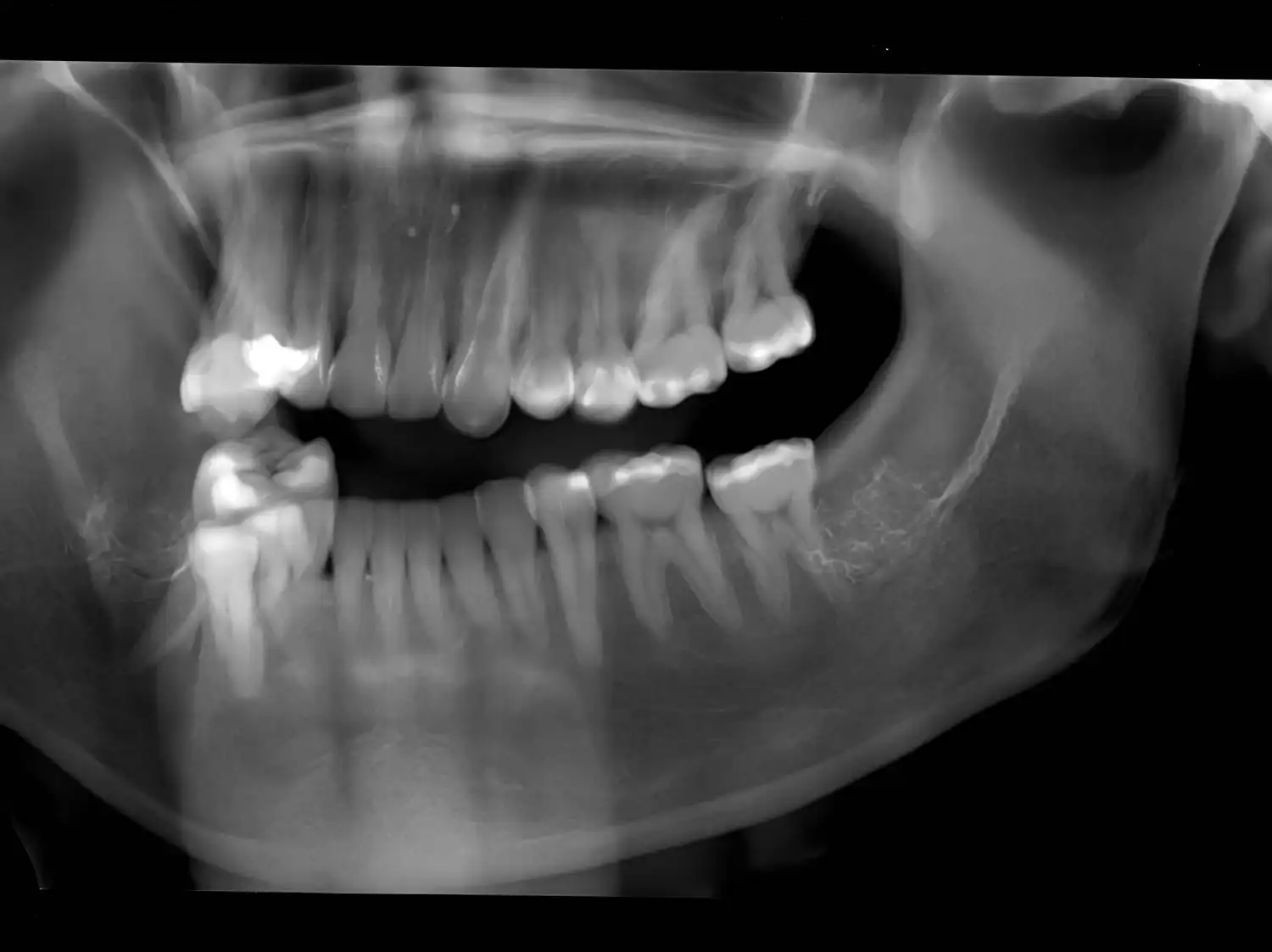 Concluye la Fase I del ensayo clínico del anticuerpo TRG035 diseñado para la regeneración dental