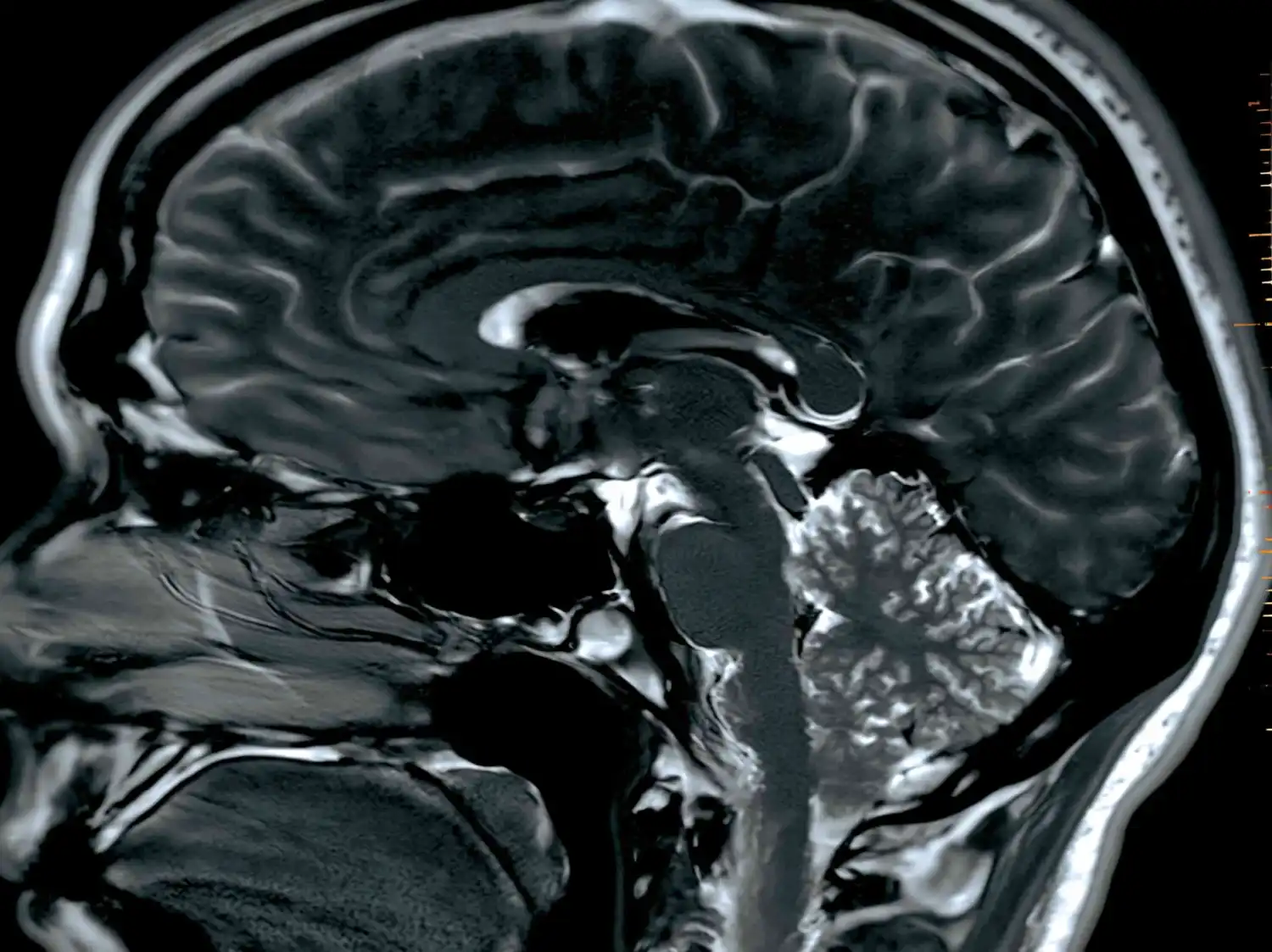 Medicina e infectología: Caso clínico en España revela diagnóstico de neurocisticercosis por larvas de tenia en un paciente sospechoso de cáncer cerebral