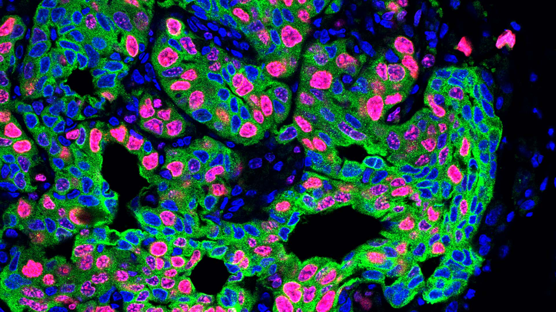El estrés crónico propaga el cáncer... aquí te explicamos cómo