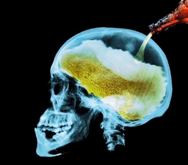 ESTUDIO: Alcoholismo se relaciona con el volumen de materia gris