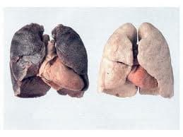 Ciencia: El consumo de cannabis no afecta a la función pulmonar según un amplio estudio