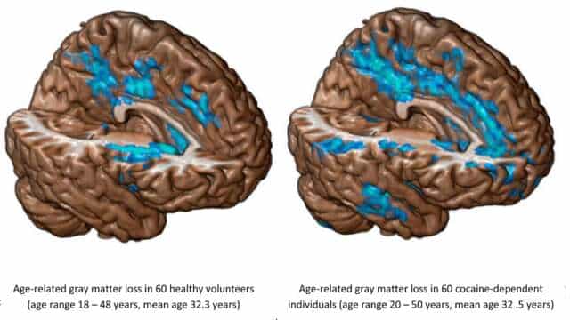 Una sola dosis de cocaína es suficiente para alterar el cerebro