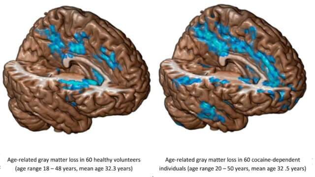 Una sola dosis de cocaína es suficiente para alterar el cerebro